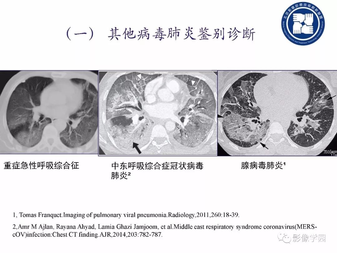 【PPT】新型冠状病毒肺炎影像学诊断指南解读
