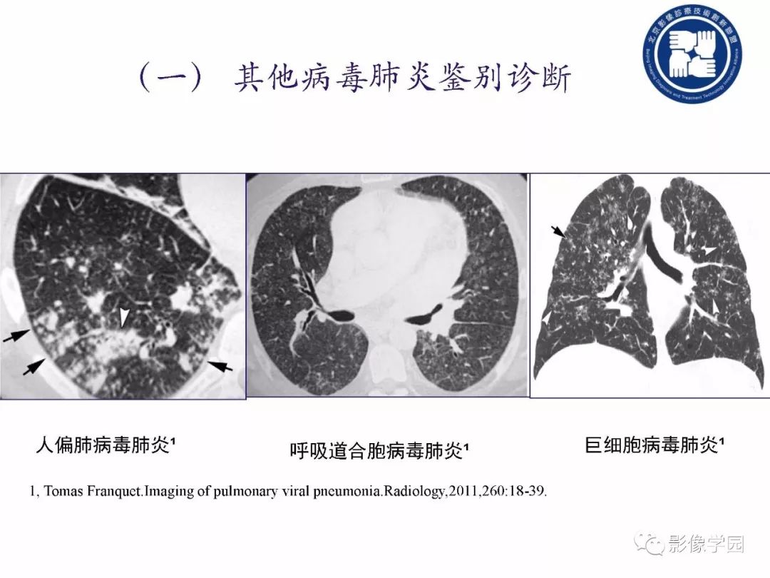 【PPT】新型冠状病毒肺炎影像学诊断指南解读