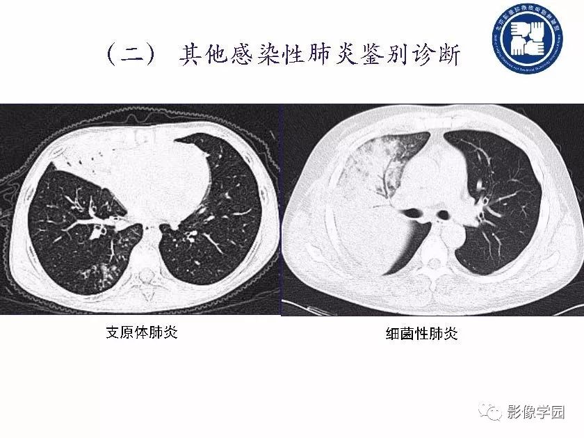 【PPT】新型冠状病毒肺炎影像学诊断指南解读