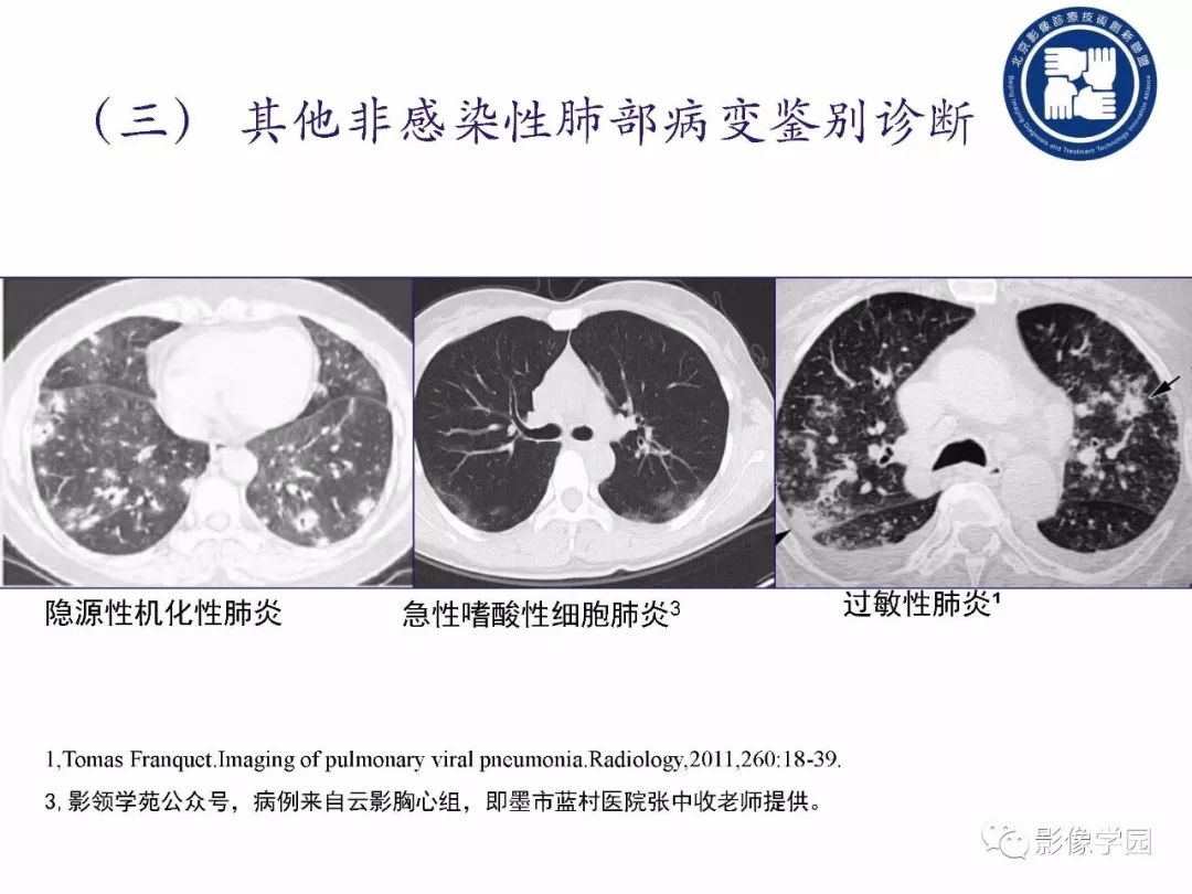 【PPT】新型冠状病毒肺炎影像学诊断指南解读