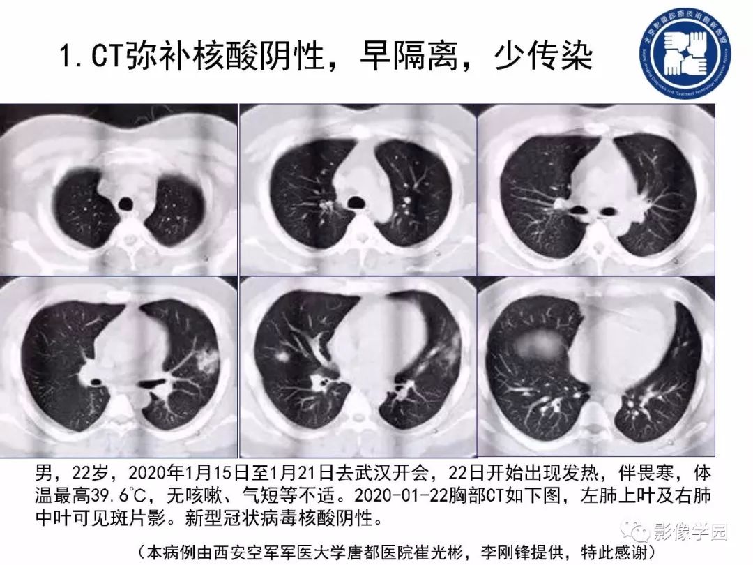 【PPT】新型冠状病毒肺炎影像学诊断指南解读