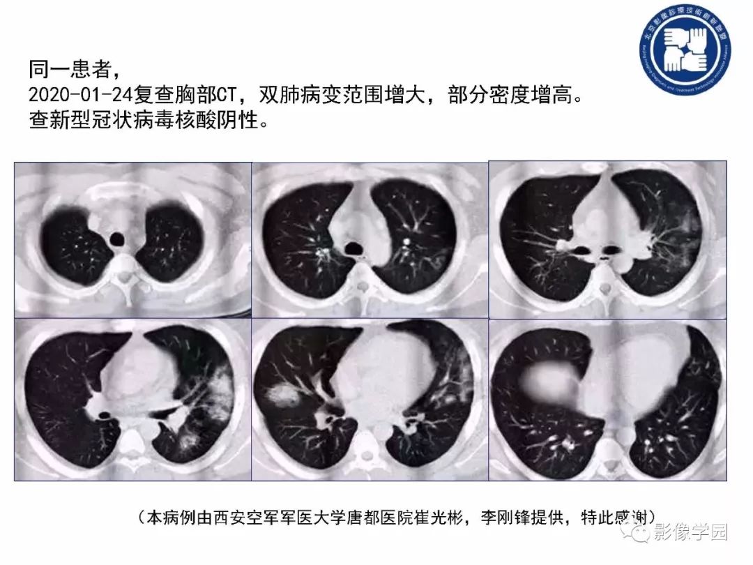 【PPT】新型冠状病毒肺炎影像学诊断指南解读
