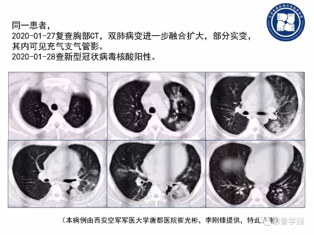 【PPT】新型冠状病毒肺炎影像学诊断指南解读