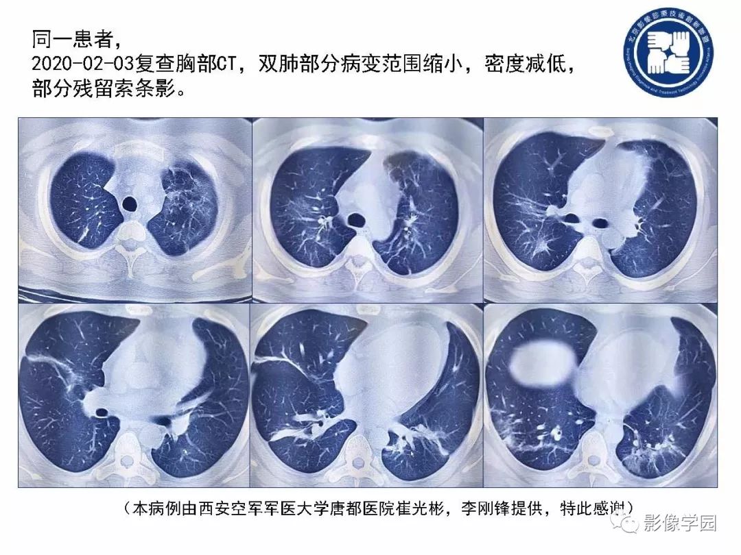 【PPT】新型冠状病毒肺炎影像学诊断指南解读