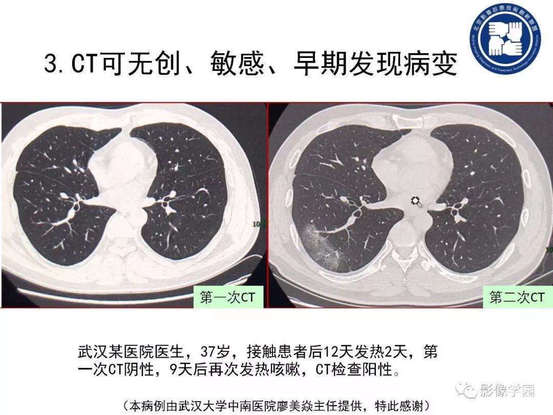 【PPT】新型冠状病毒肺炎影像学诊断指南解读