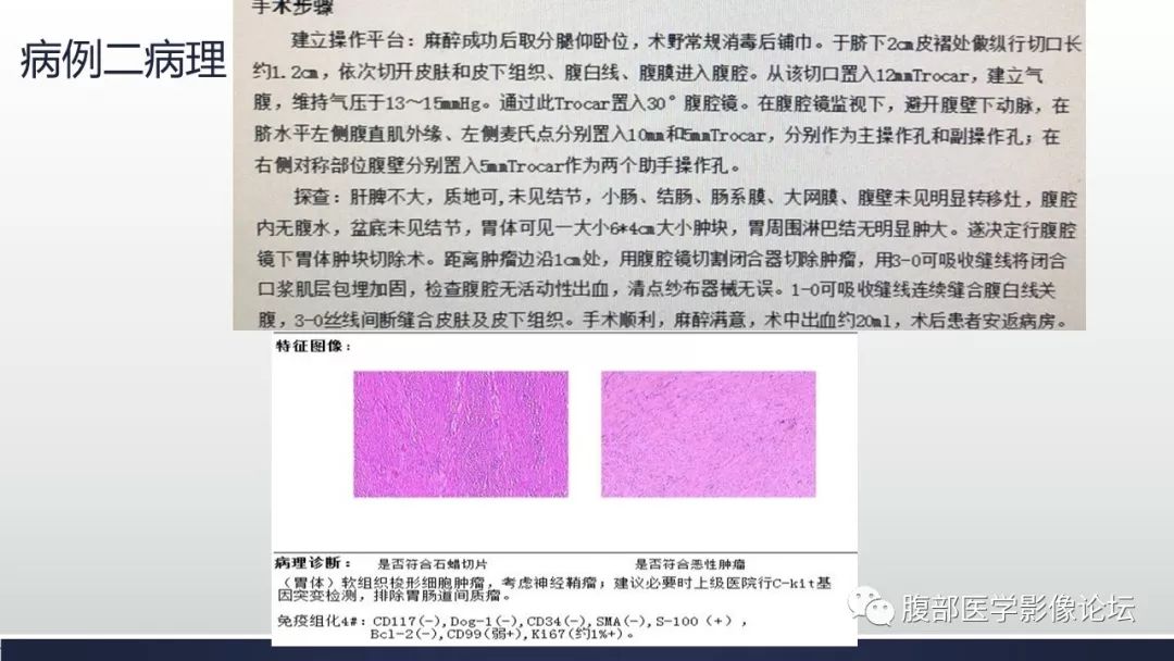 【病例】胃体神经鞘瘤1例CT影像