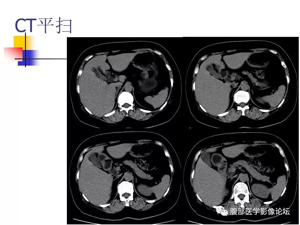 【病例】环状胰腺1例CT影像表现 【病例】环状胰腺1例CT影像表现