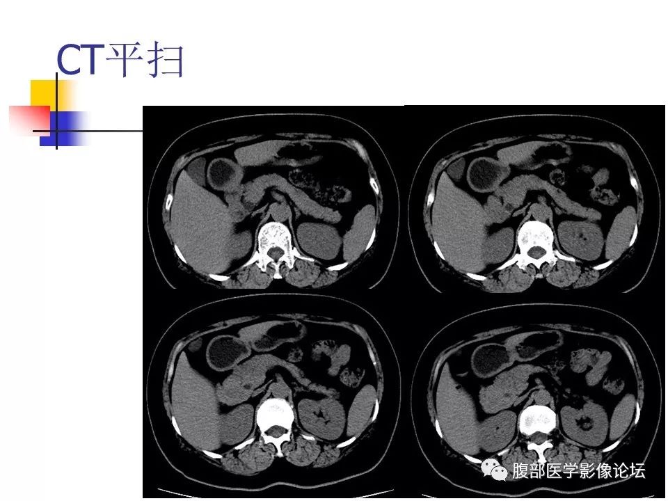 【病例】环状胰腺1例CT影像表现 【病例】环状胰腺1例CT影像表现