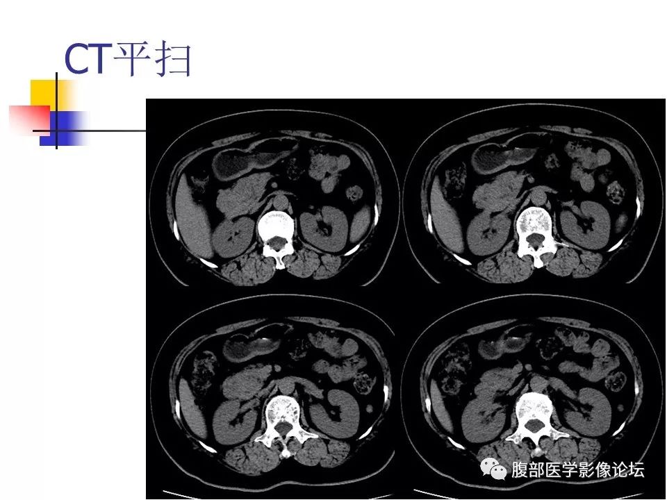 【病例】环状胰腺1例CT影像表现 【病例】环状胰腺1例CT影像表现