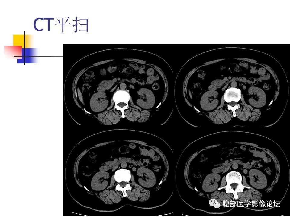 【病例】环状胰腺1例CT影像表现 【病例】环状胰腺1例CT影像表现
