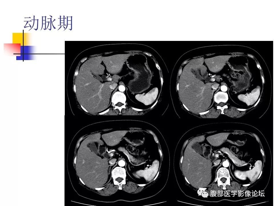 【病例】环状胰腺1例CT影像表现 【病例】环状胰腺1例CT影像表现