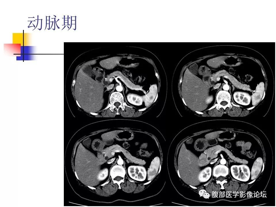 【病例】环状胰腺1例CT影像表现 【病例】环状胰腺1例CT影像表现