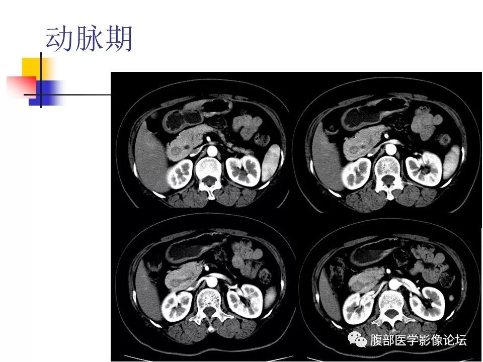 【病例】环状胰腺1例CT影像表现 【病例】环状胰腺1例CT影像表现