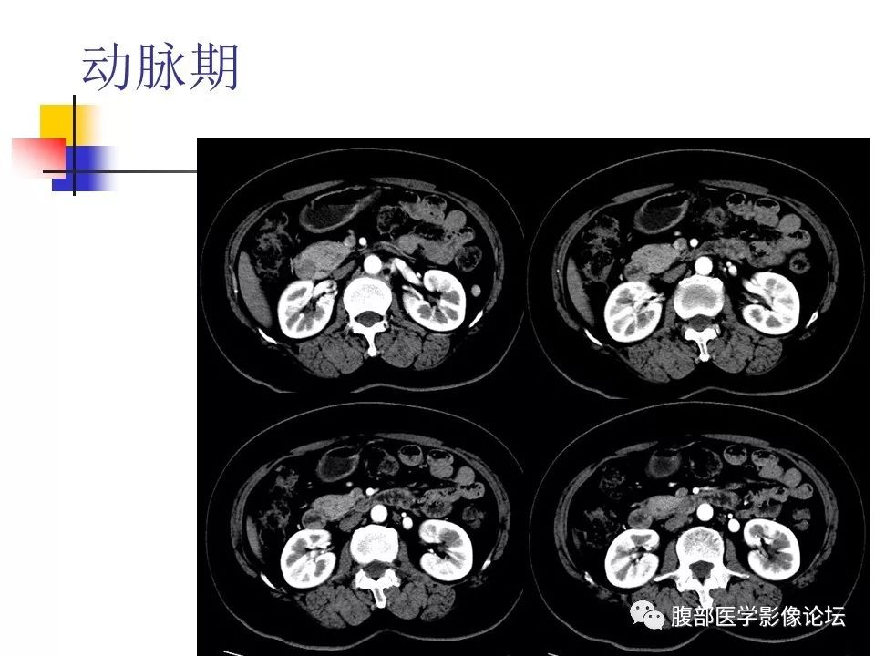 【病例】环状胰腺1例CT影像表现 【病例】环状胰腺1例CT影像表现