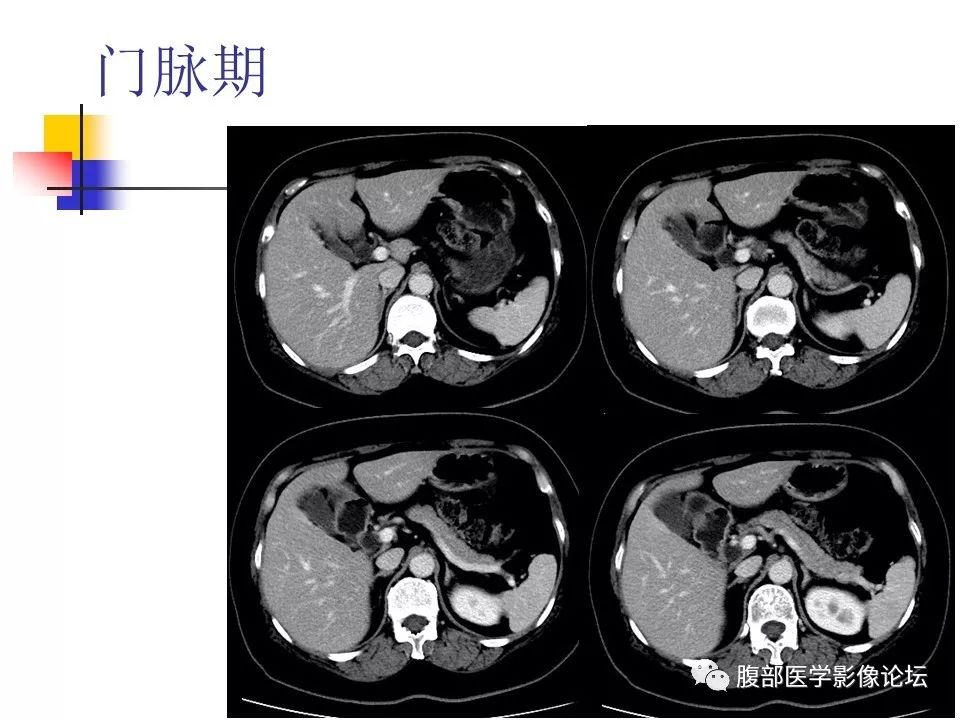 【病例】环状胰腺1例CT影像表现 【病例】环状胰腺1例CT影像表现