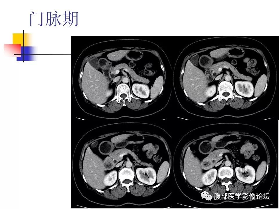 【病例】环状胰腺1例CT影像表现 【病例】环状胰腺1例CT影像表现