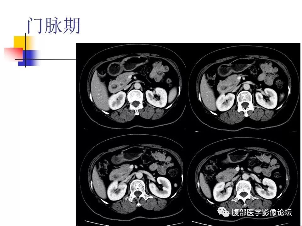 【病例】环状胰腺1例CT影像表现 【病例】环状胰腺1例CT影像表现
