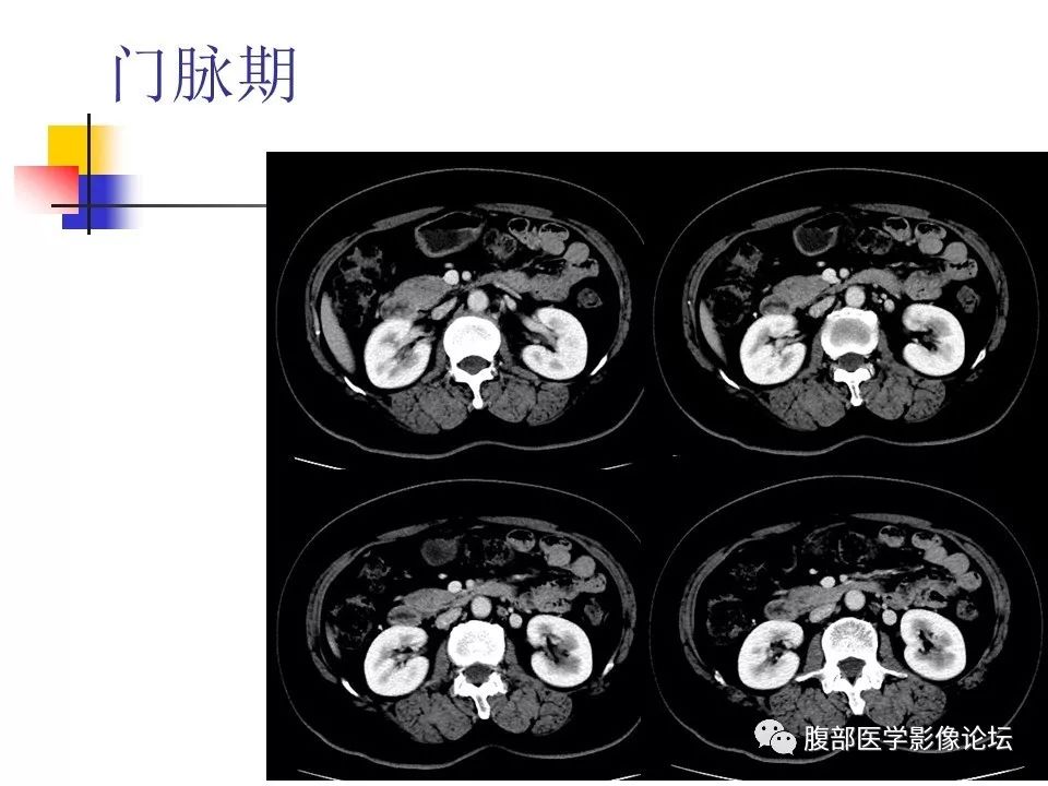 【病例】环状胰腺1例CT影像表现 【病例】环状胰腺1例CT影像表现