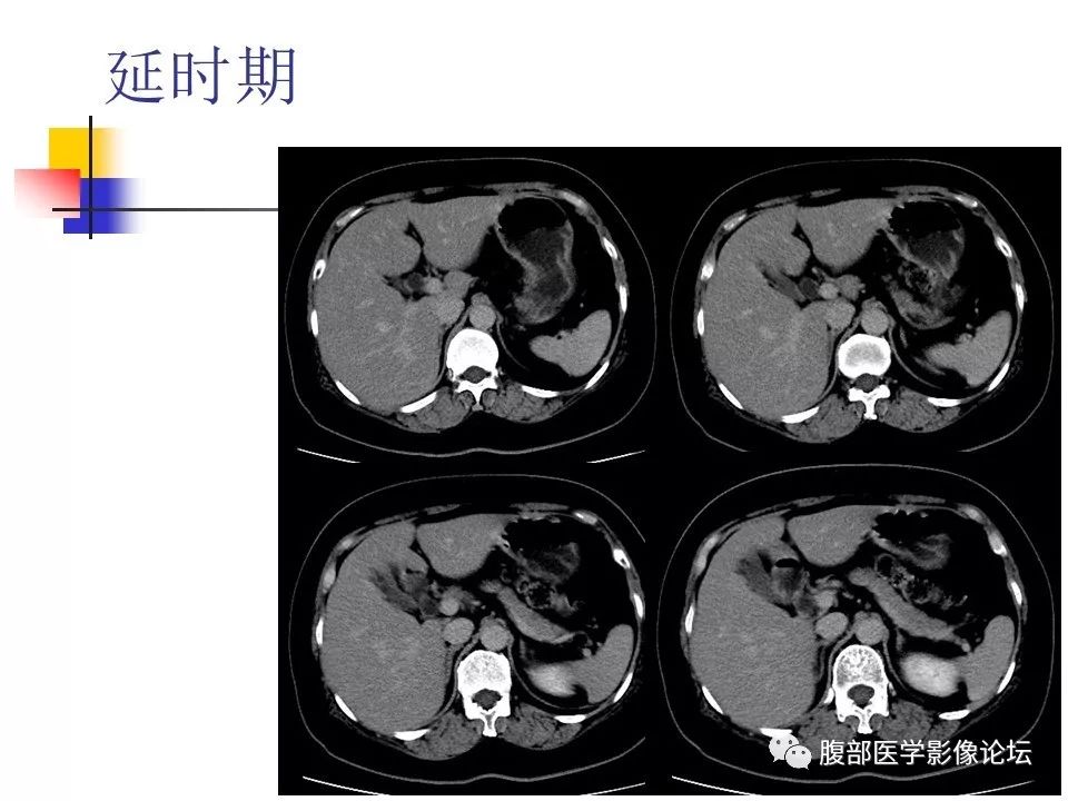 【病例】环状胰腺1例CT影像表现 【病例】环状胰腺1例CT影像表现