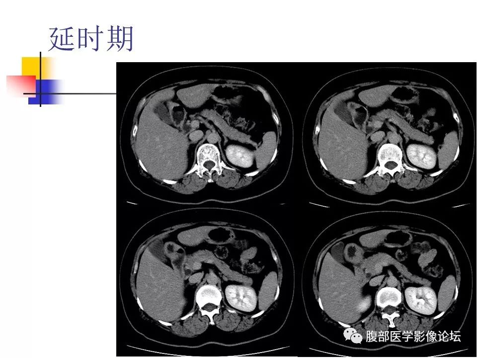 【病例】环状胰腺1例CT影像表现 【病例】环状胰腺1例CT影像表现