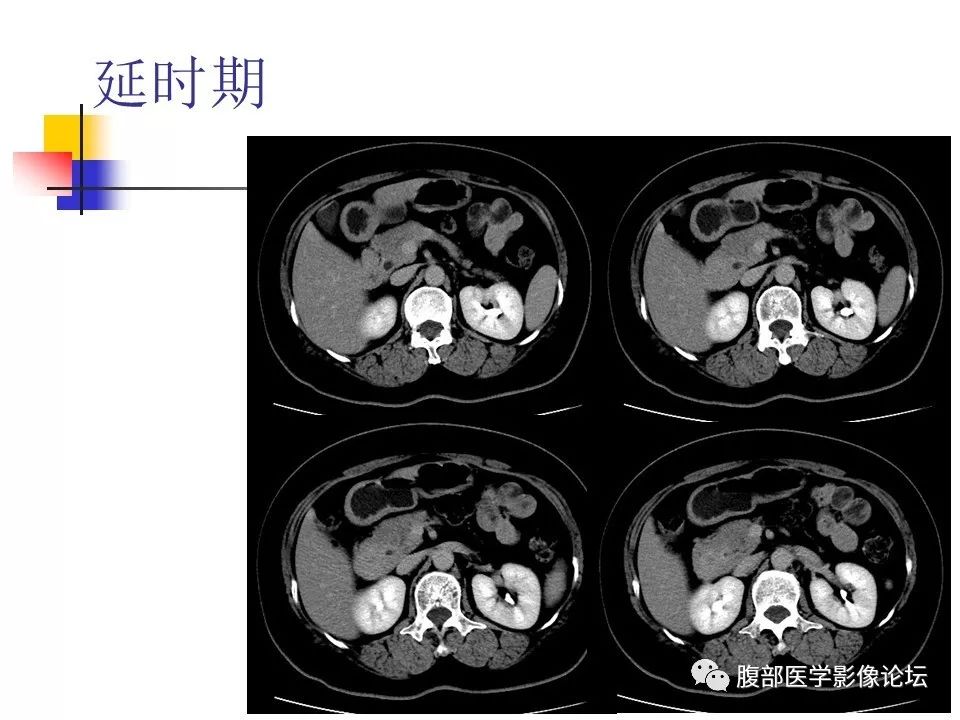 【病例】环状胰腺1例CT影像表现 【病例】环状胰腺1例CT影像表现