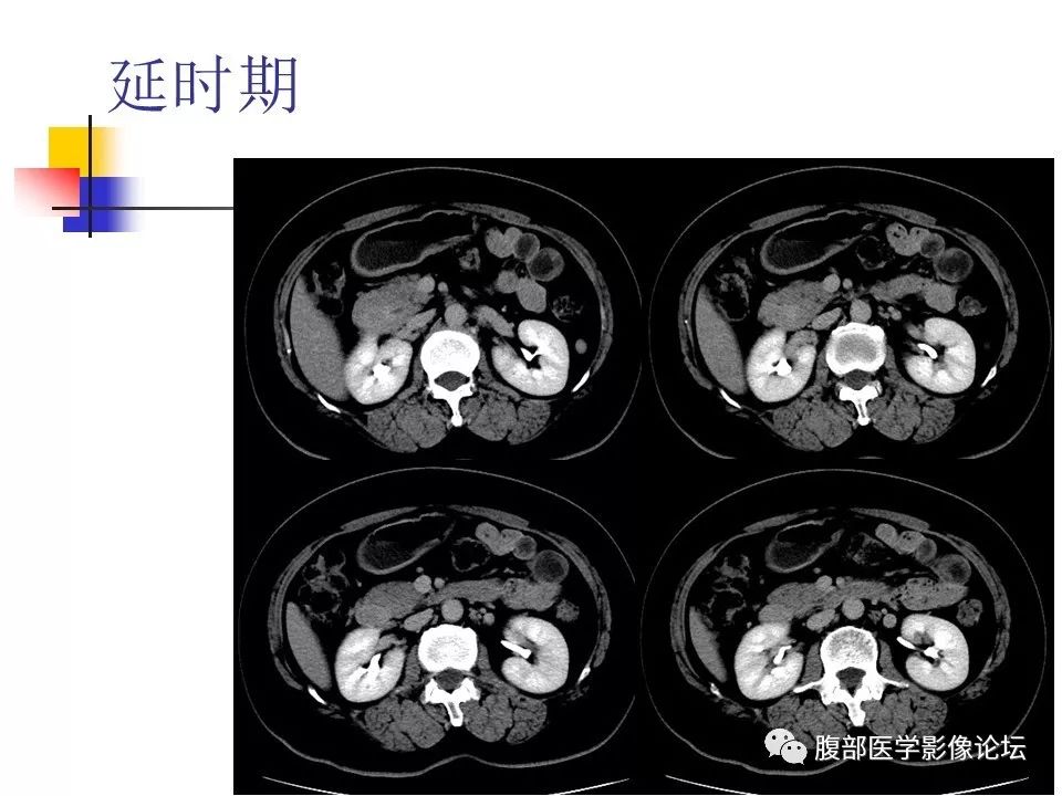 【病例】环状胰腺1例CT影像表现 【病例】环状胰腺1例CT影像表现
