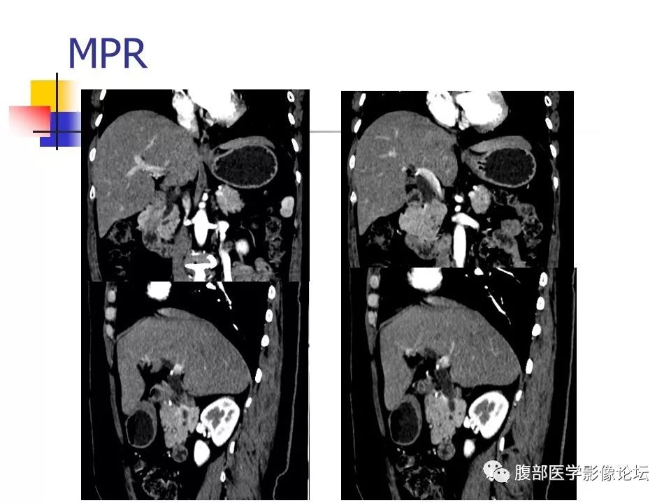 【病例】环状胰腺1例CT影像表现 【病例】环状胰腺1例CT影像表现
