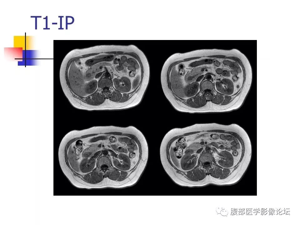 【病例】环状胰腺1例CT影像表现 【病例】环状胰腺1例CT影像表现