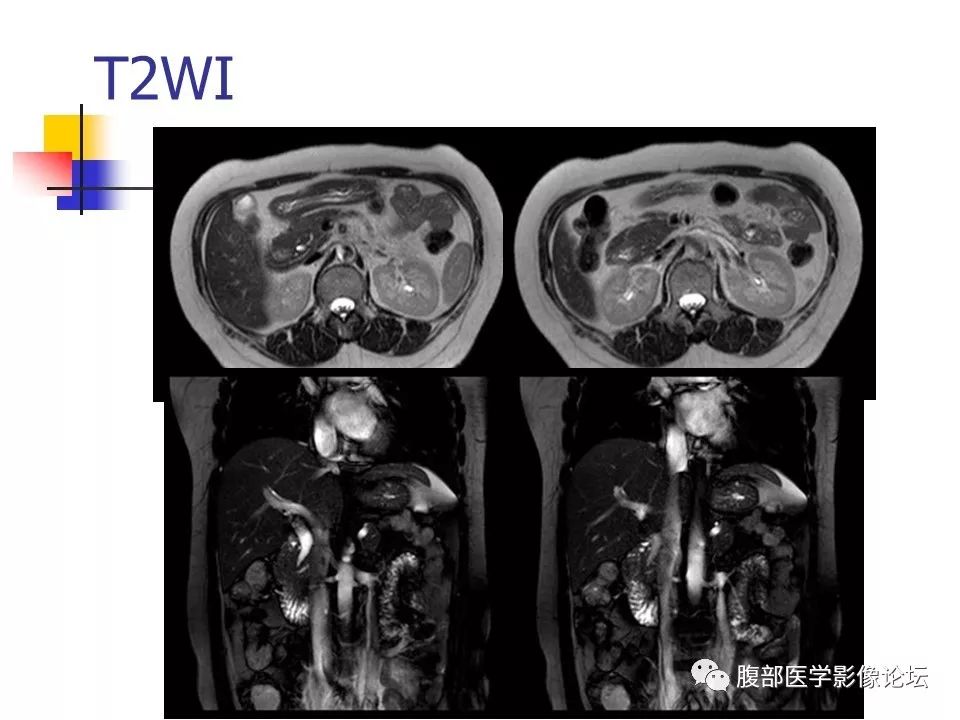 【病例】环状胰腺1例CT影像表现 【病例】环状胰腺1例CT影像表现