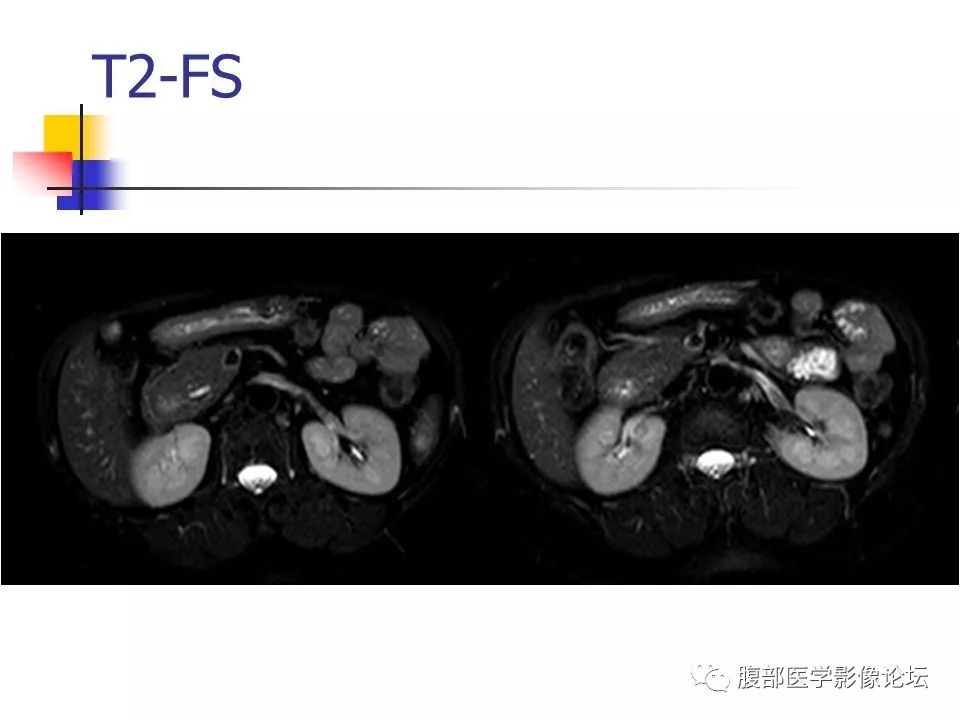 【病例】环状胰腺1例CT影像表现 【病例】环状胰腺1例CT影像表现