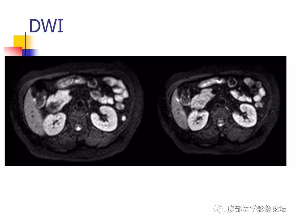 【病例】环状胰腺1例CT影像表现 【病例】环状胰腺1例CT影像表现