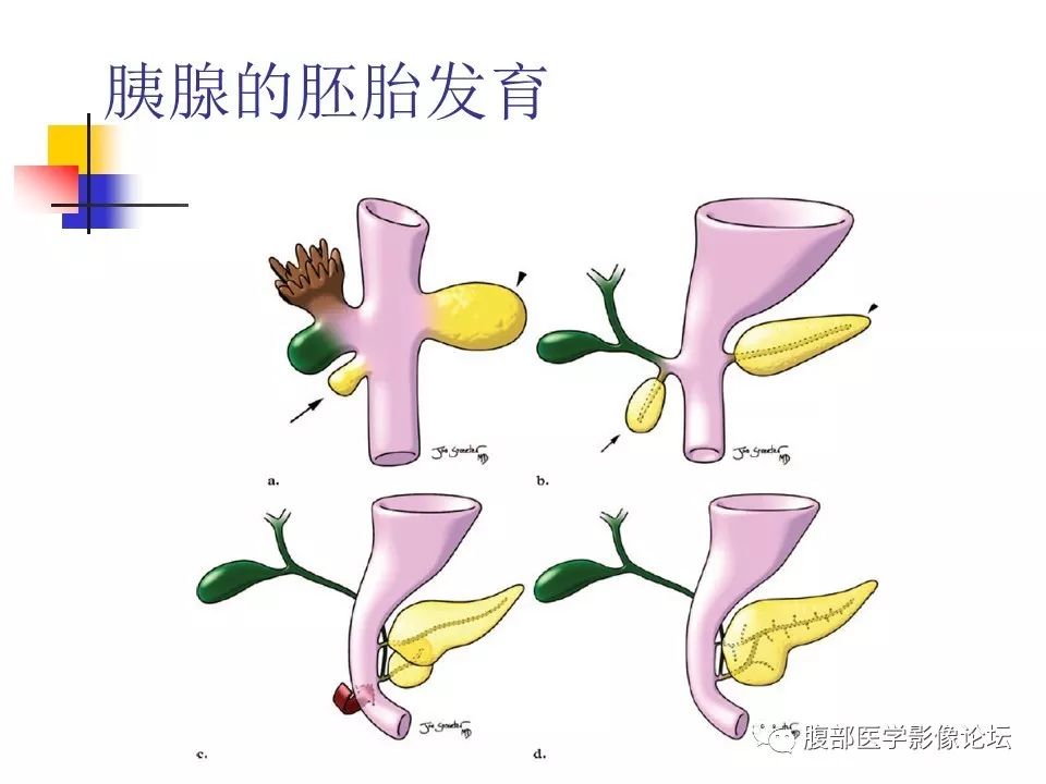 【病例】环状胰腺1例CT影像表现 【病例】环状胰腺1例CT影像表现