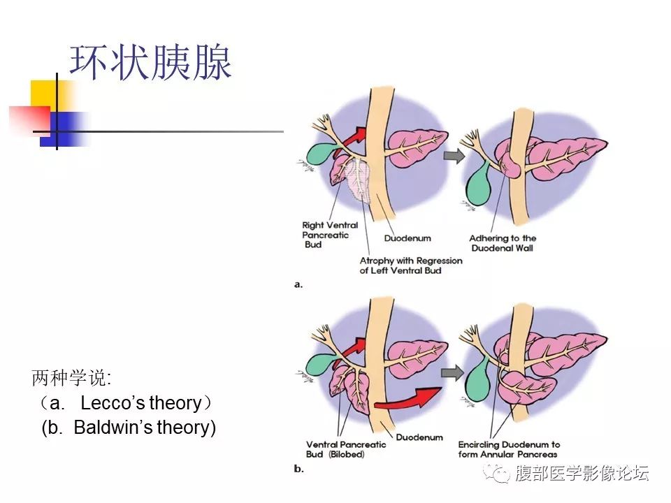 【病例】环状胰腺1例CT影像表现 【病例】环状胰腺1例CT影像表现