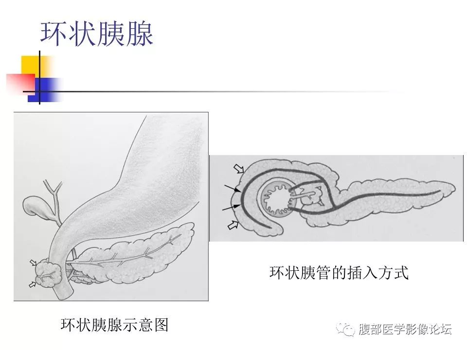 【病例】环状胰腺1例CT影像表现 【病例】环状胰腺1例CT影像表现