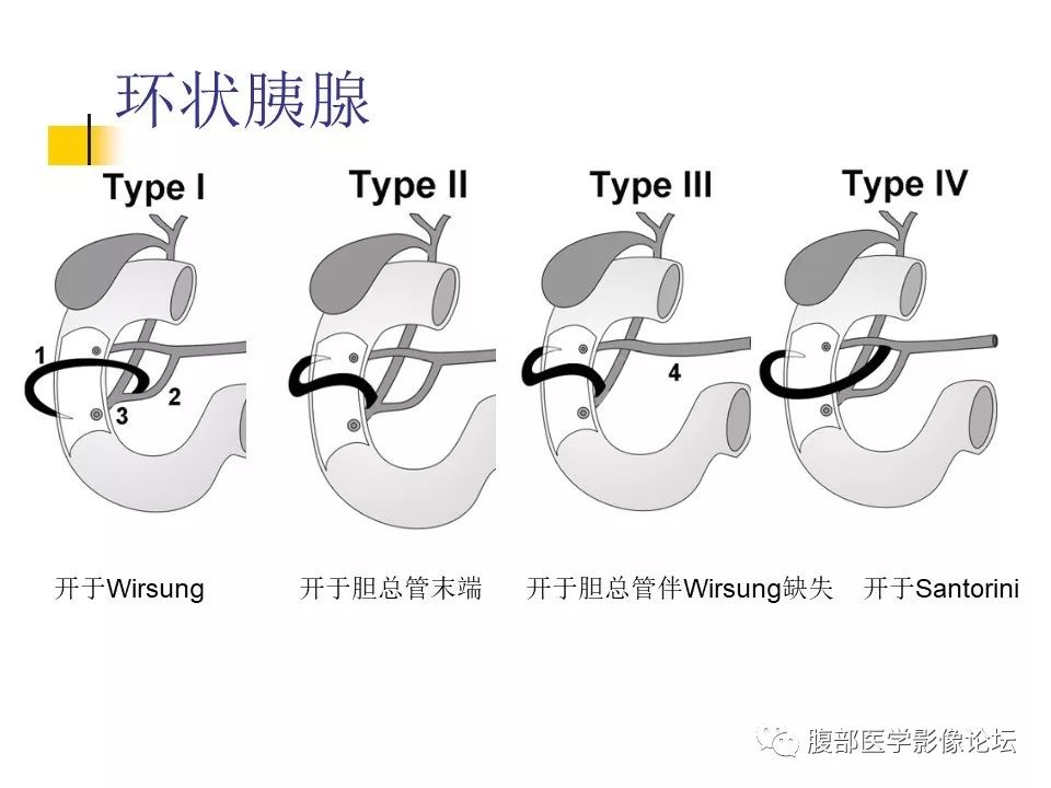 【病例】环状胰腺1例CT影像表现 【病例】环状胰腺1例CT影像表现
