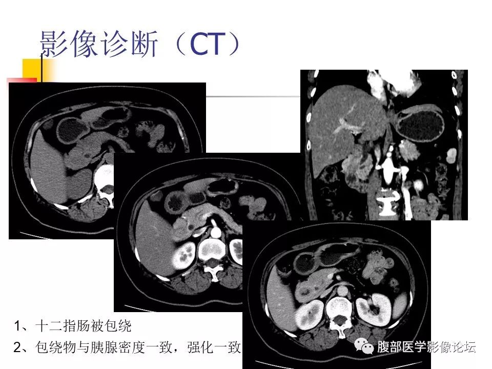 【病例】环状胰腺1例CT影像表现 【病例】环状胰腺1例CT影像表现
