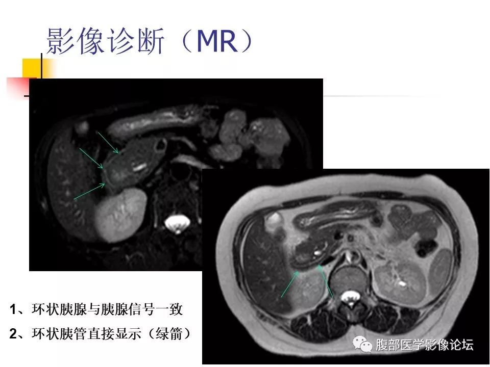 【病例】环状胰腺1例CT影像表现 【病例】环状胰腺1例CT影像表现