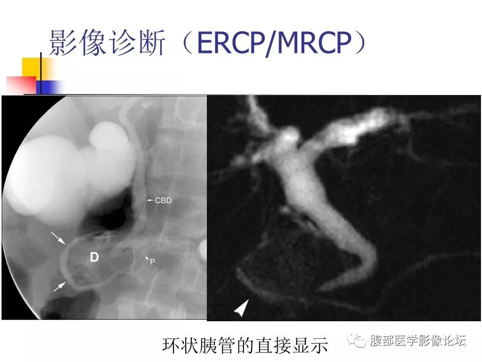 【病例】环状胰腺1例CT影像表现 【病例】环状胰腺1例CT影像表现