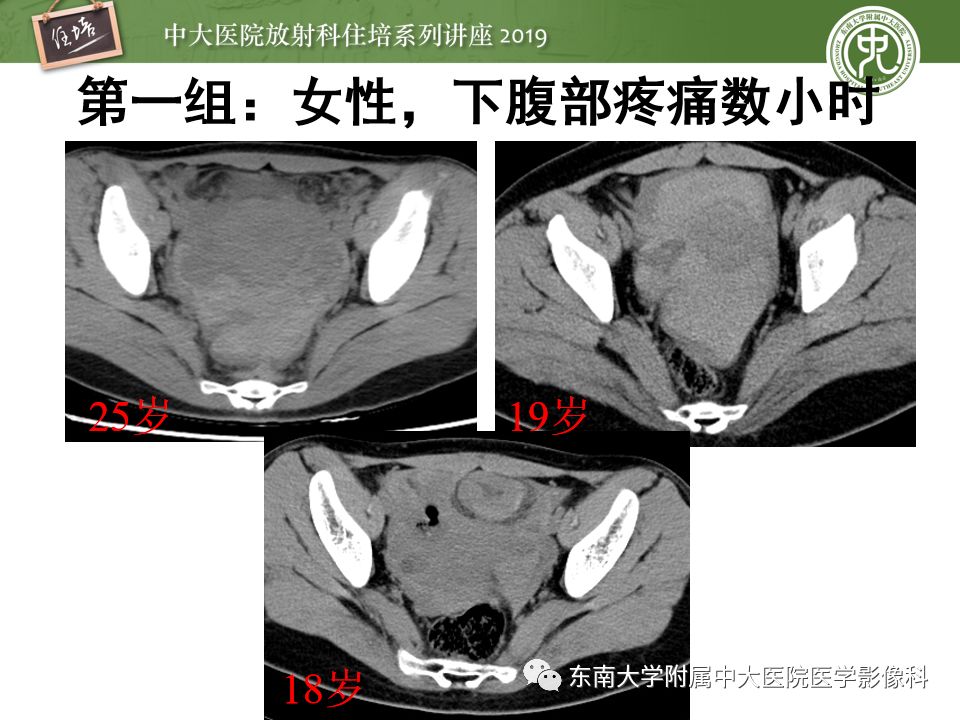 【PPT】卵巢急腹症影像学表现