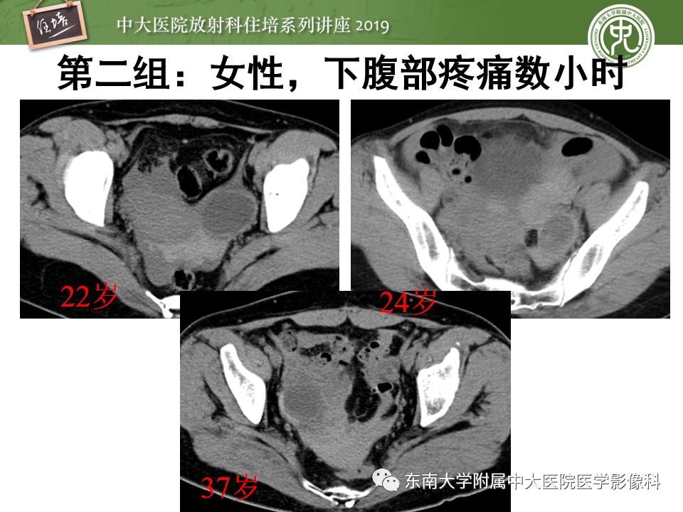 【PPT】卵巢急腹症影像学表现