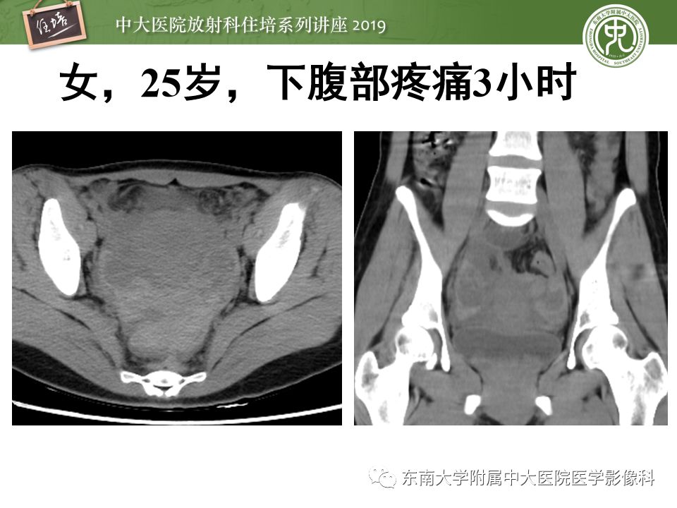 【PPT】卵巢急腹症影像学表现