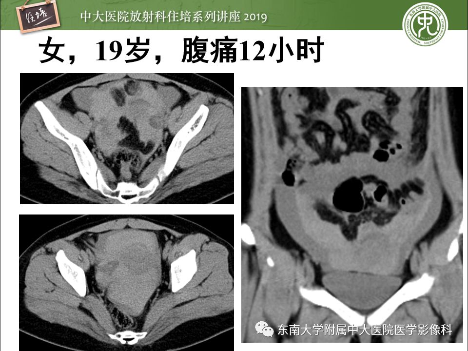 【PPT】卵巢急腹症影像学表现
