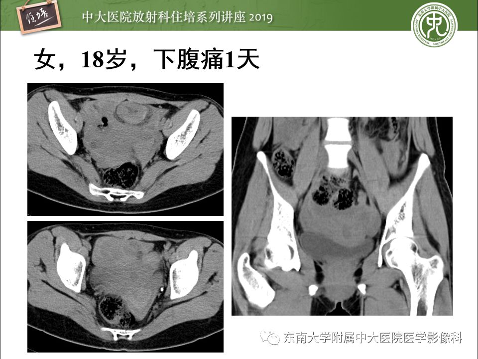 【PPT】卵巢急腹症影像学表现