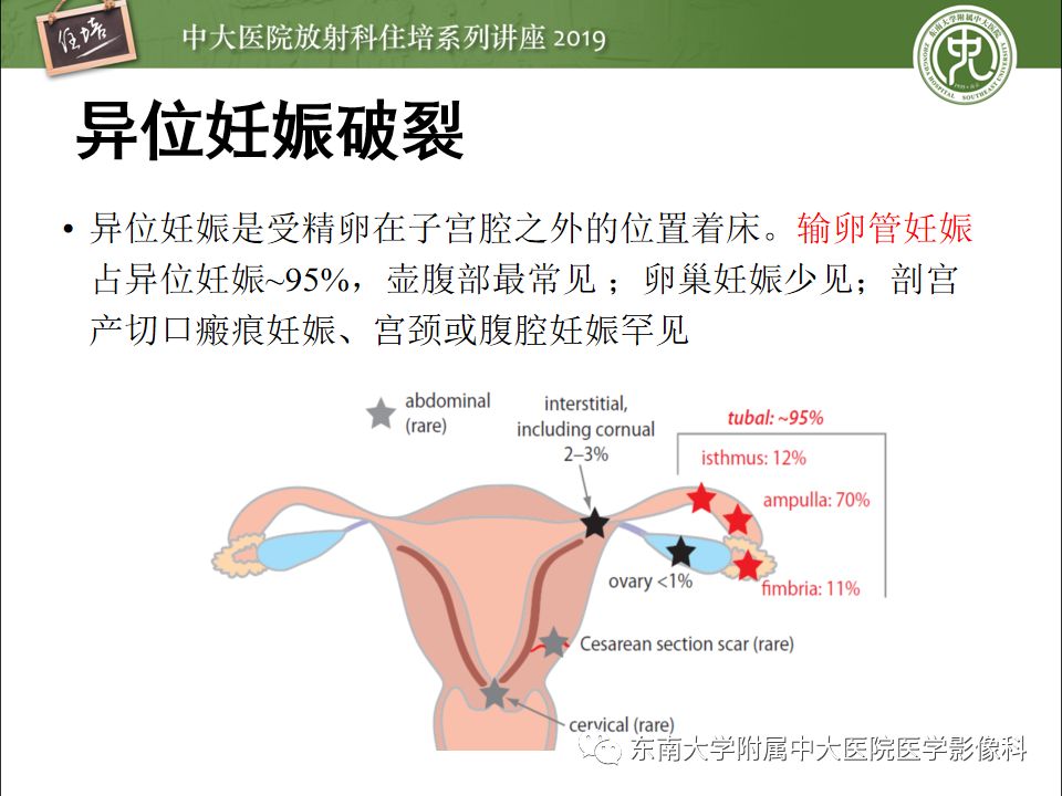 【PPT】卵巢急腹症影像学表现