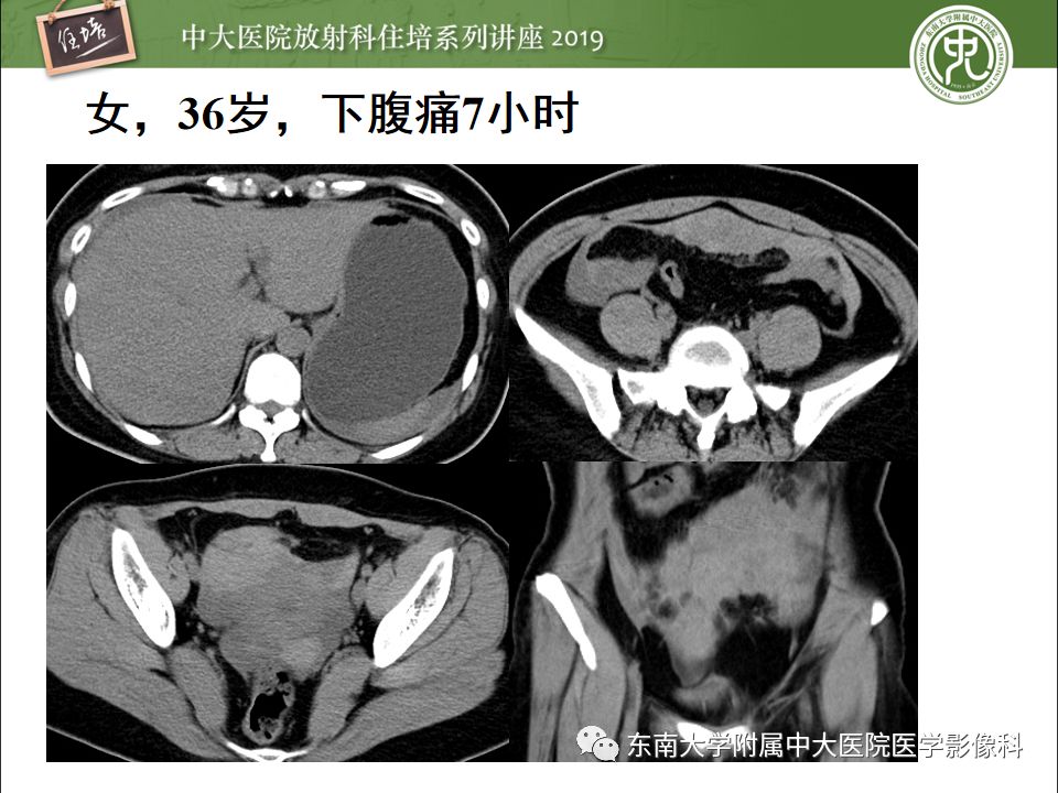 【PPT】卵巢急腹症影像学表现