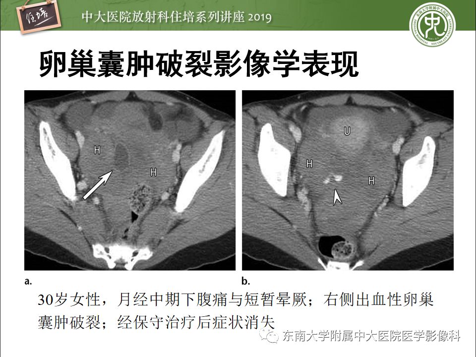 【PPT】卵巢急腹症影像学表现