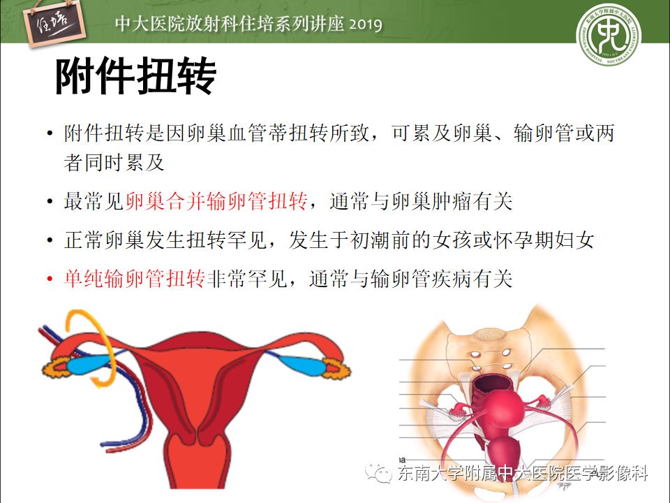 【PPT】卵巢急腹症影像学表现