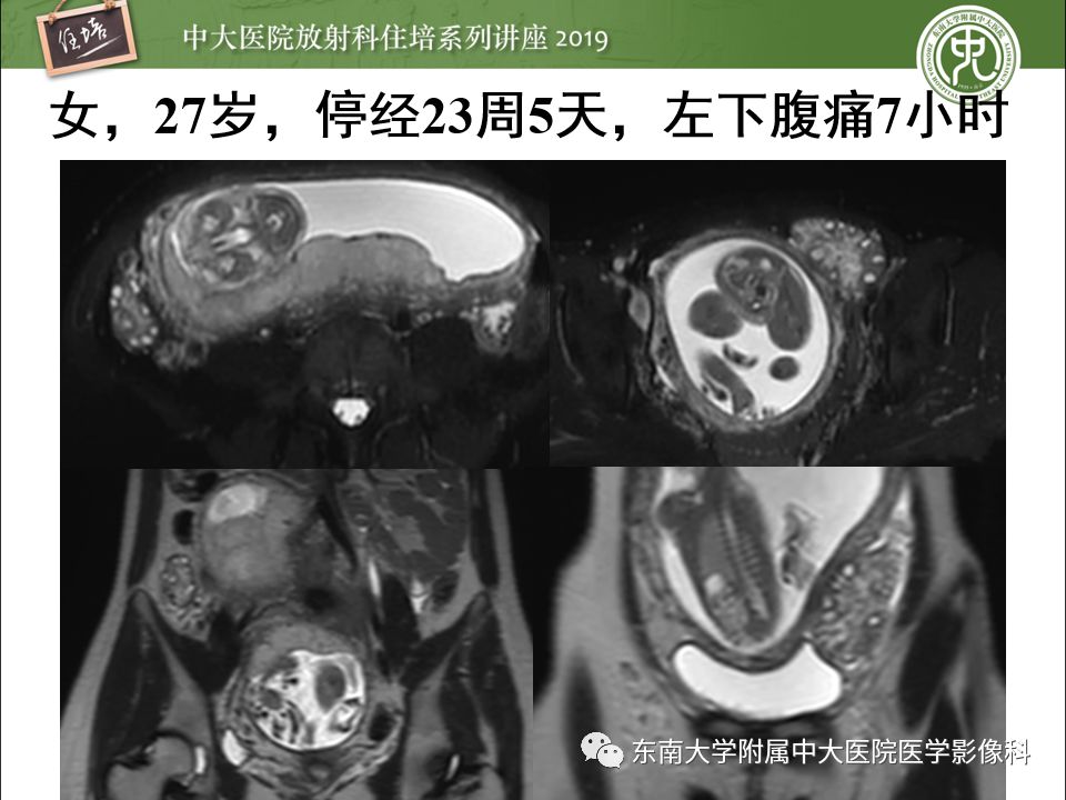 【PPT】卵巢急腹症影像学表现
