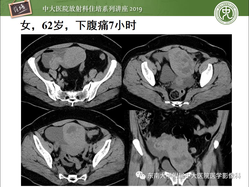 【PPT】卵巢急腹症影像学表现
