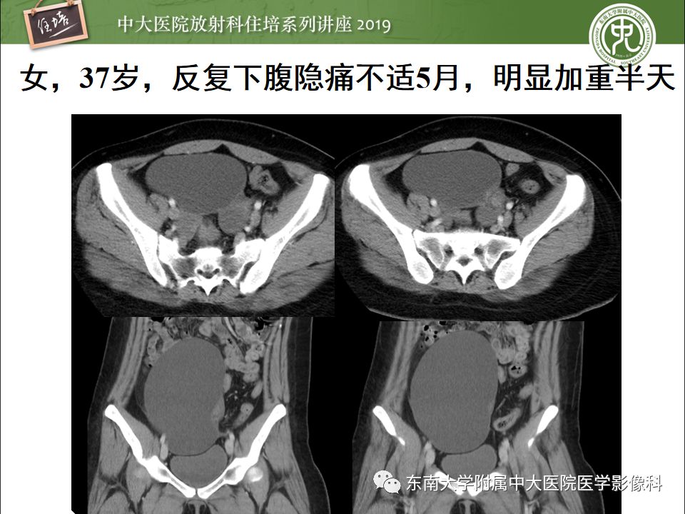 【PPT】卵巢急腹症影像学表现